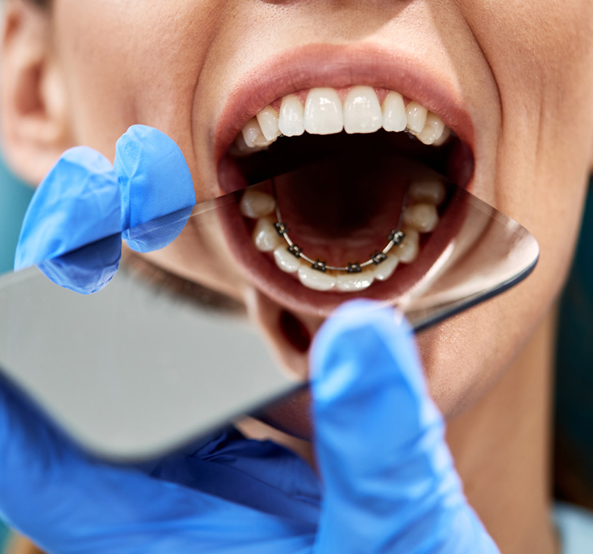 Benefits of lingual braces